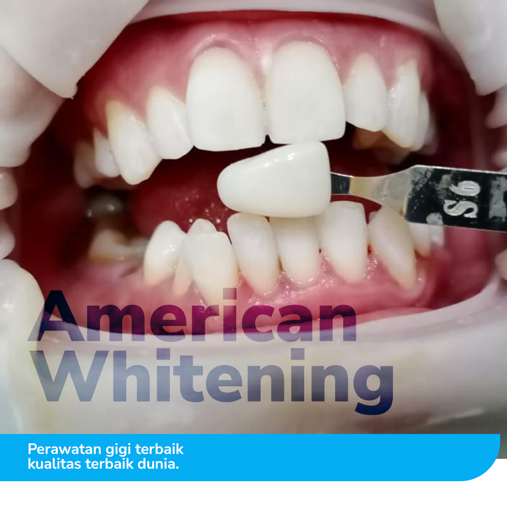 Bleaching Gigi Dengan American Whitening