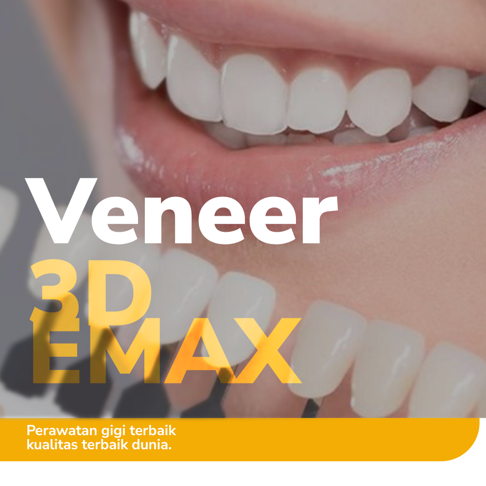 Veneer