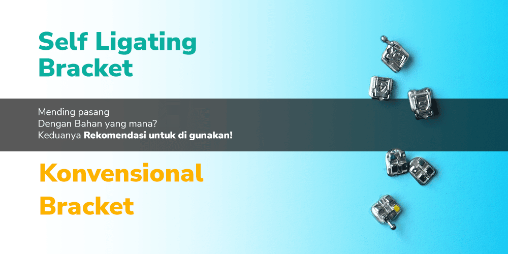 Self Ligating vs Konvensional Behel