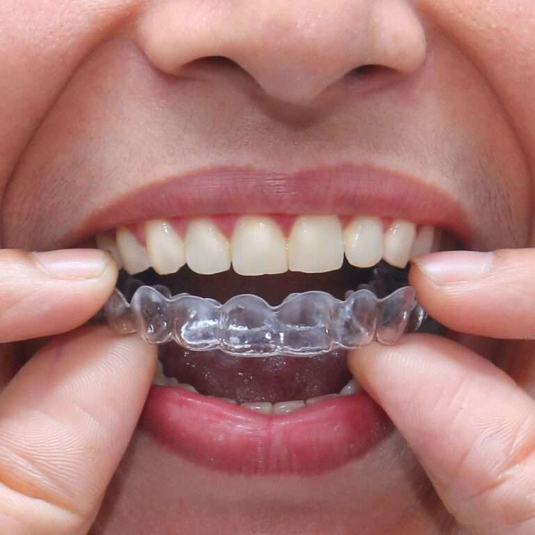 Aligner Gigi
