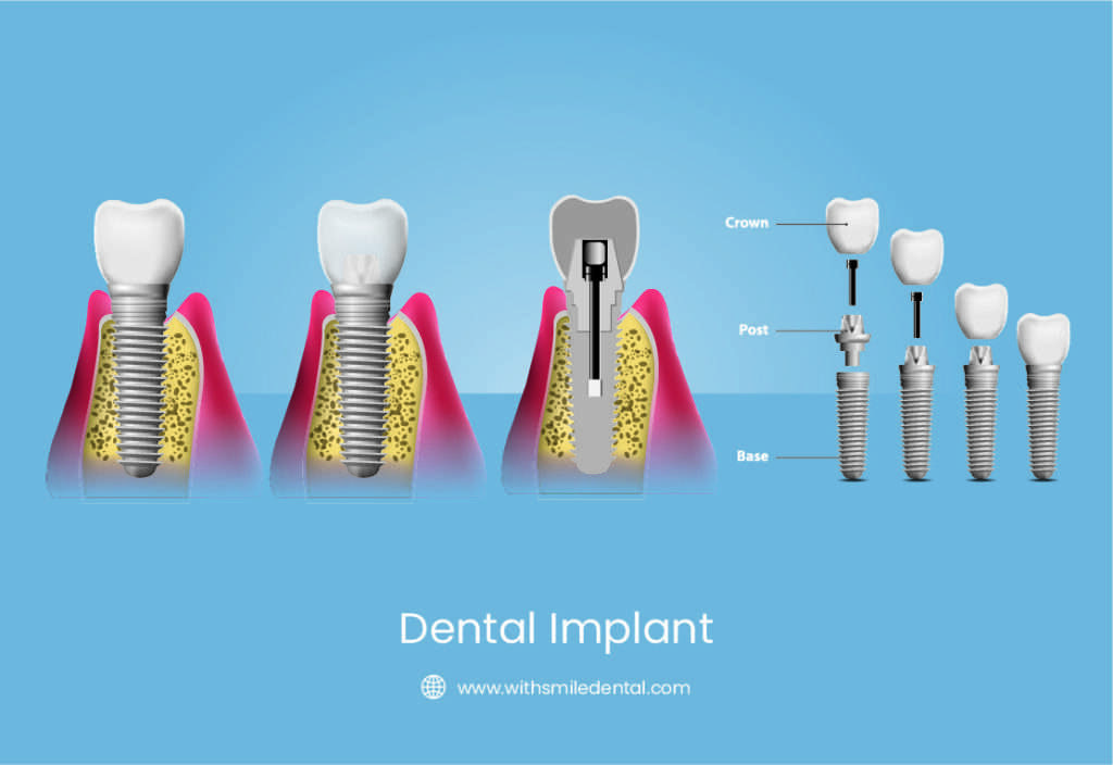 Dental Implant Landscape