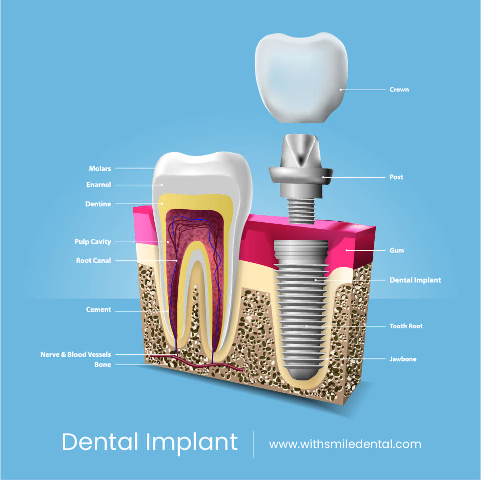 Dental Implant Square