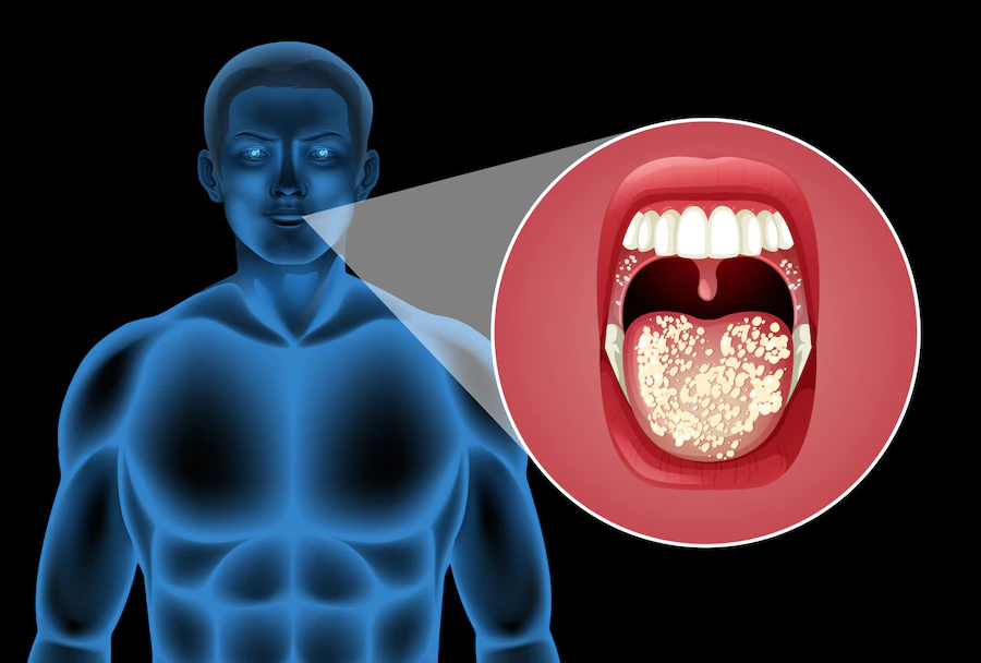 oral cancer