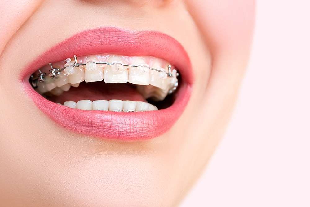 Behel Self Ligating