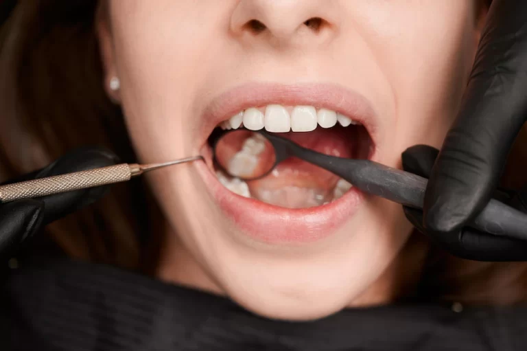 tooth fillings