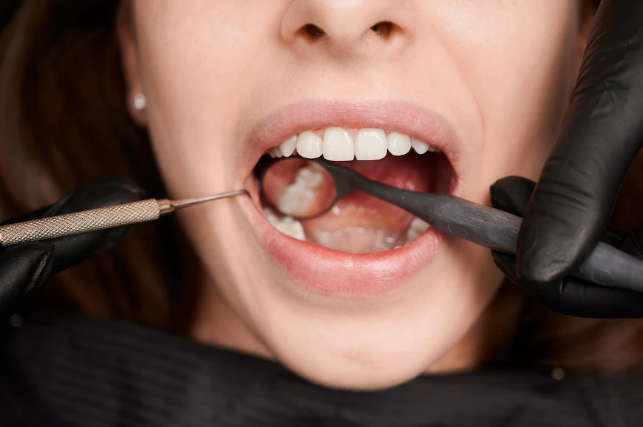tooth fillings