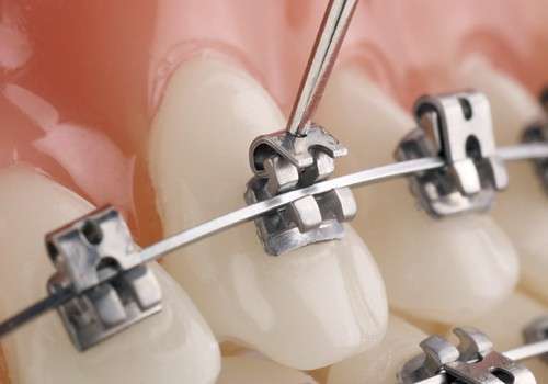 Self Ligating